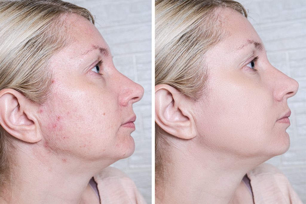 IPL Acne-1-before after