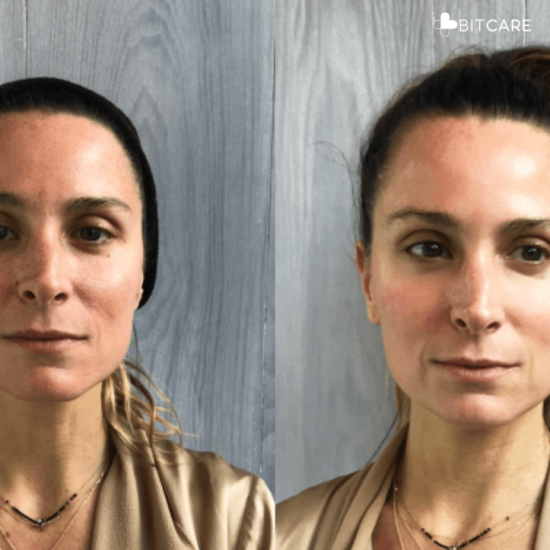 Before and after images showcasing the remarkable transformation after a cryofacial treatment.