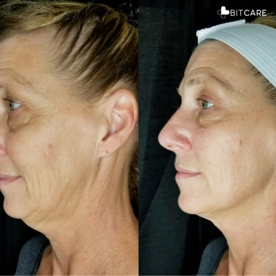 Before and after images showcasing the remarkable transformation after a cryofacial treatment.