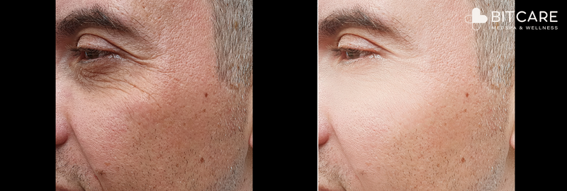 Botox Before and After: Dramatic transformation showing reduced wrinkles and improved skin texture.