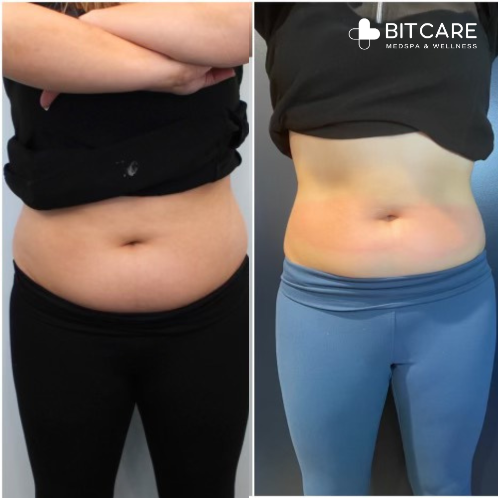 Cryo slimming and toning- before after