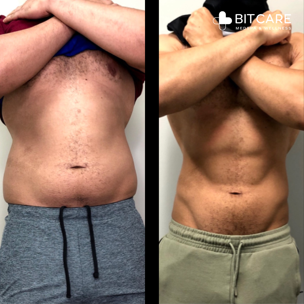 Cryo slimming and toning- before after