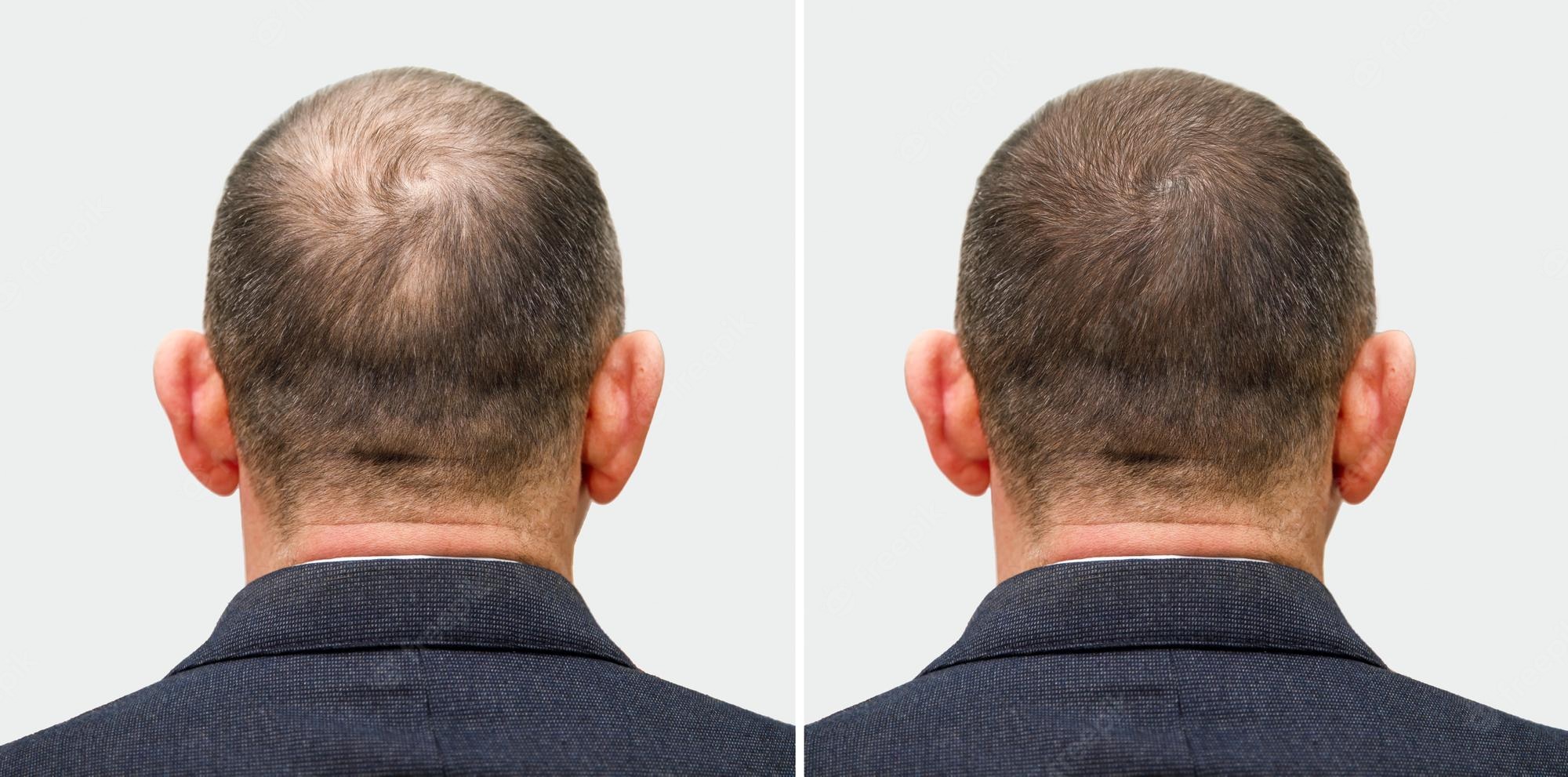 before-after-hair-transplant