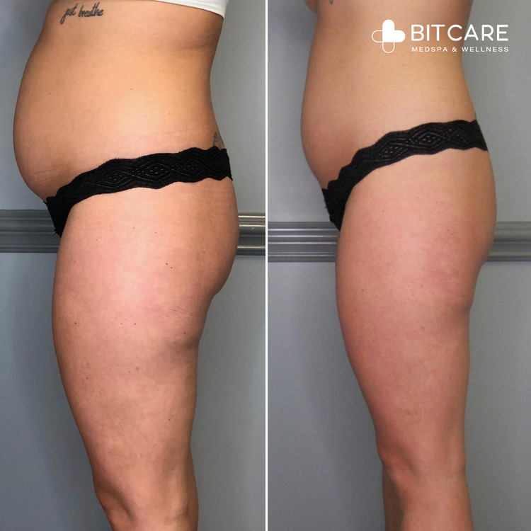 Before and After Cryoskin Results