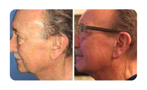 Viora Skin Tightening before-after