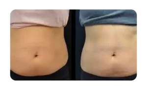 Cryoskin Body Sculpting​ before-after