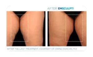 Cryoskin Body Sculpting​ before-after