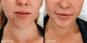 Microneedling_before_after