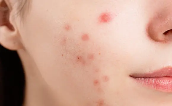 Acne Awareness Month Acne Acne Scars