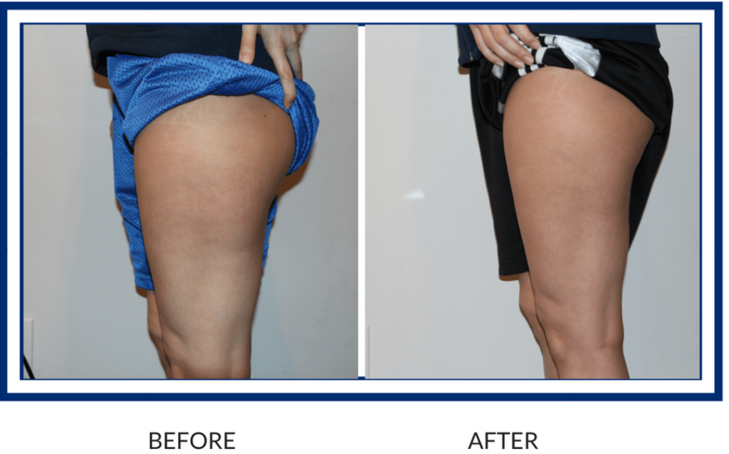 Before and After of Cryoskin Session