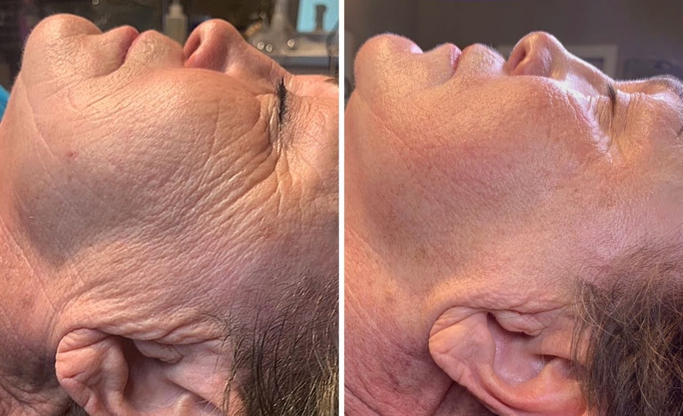 Before & After of Microneedling Treatment