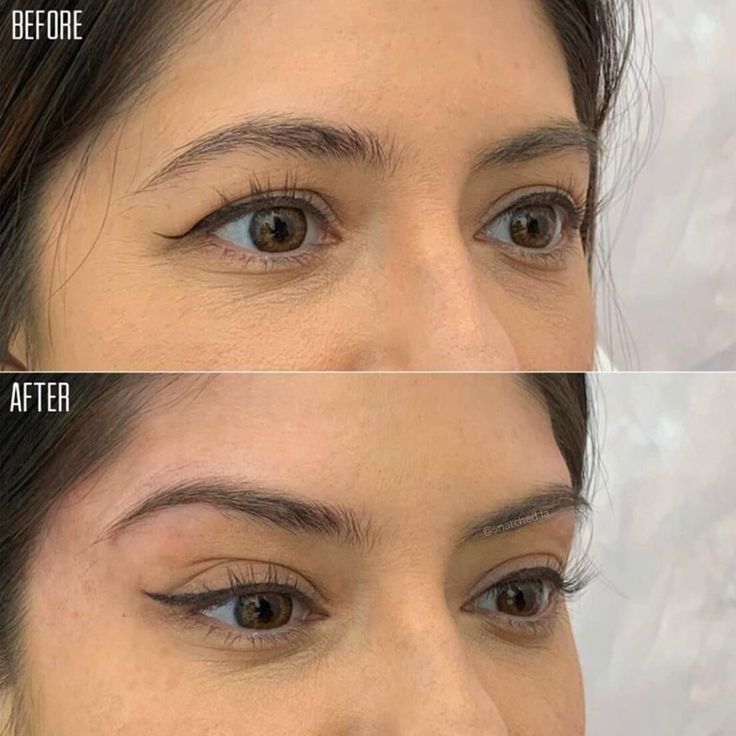 botox on brows