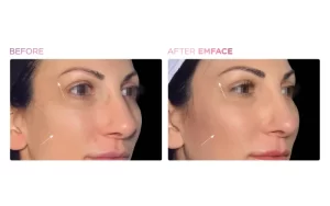 EMFACE BEFORE AND AFTER