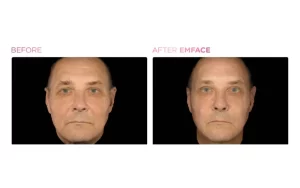 EMFACE BEFORE AND AFTER1